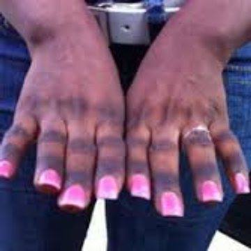 DEPIGMENTATION