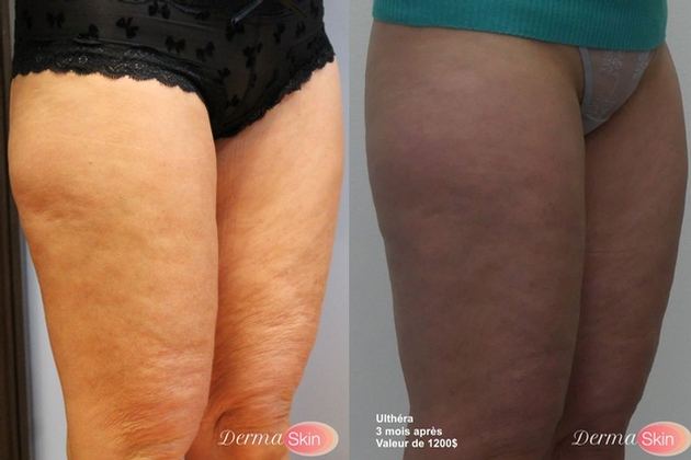 cellulite 1