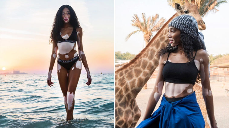 Winnie-Harlow 1